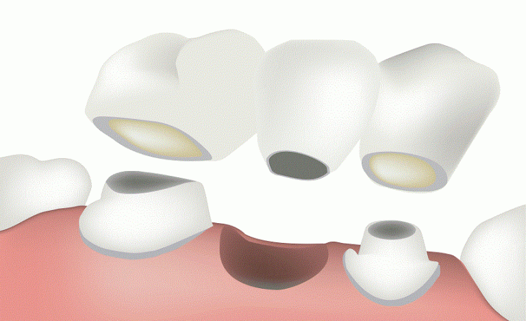 missing teeth dental options