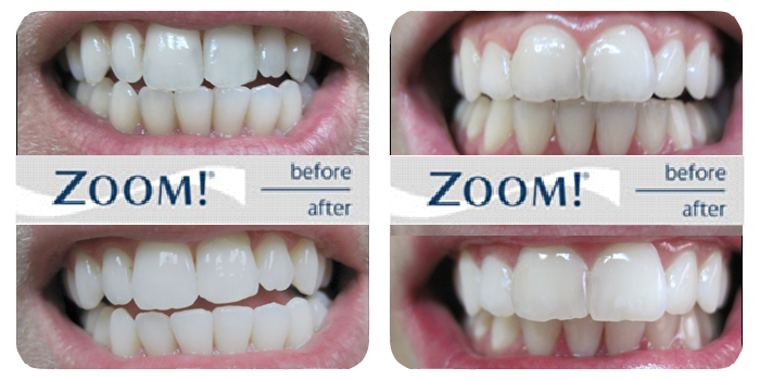 zoom teeth whitening before and after
