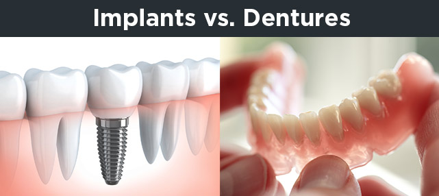 implants-vs-dentures